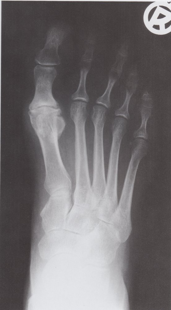 Advanced degenerative arthritis of the great toe metatarsophalangeal joint (1/2)