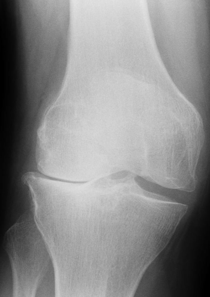 Lateral compartment osteoarthritis of the knee