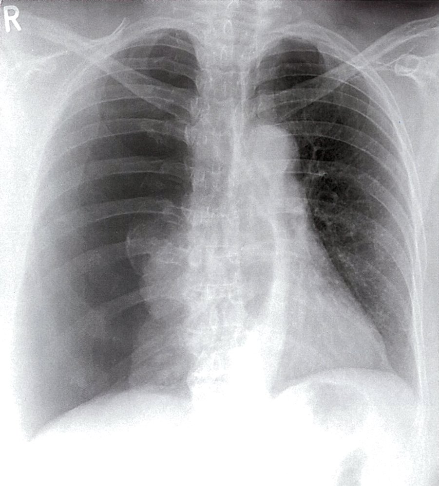Tension pneumothorax