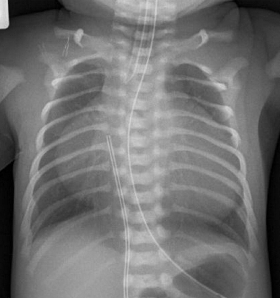 Cardiomegaly in Ebstein anomaly