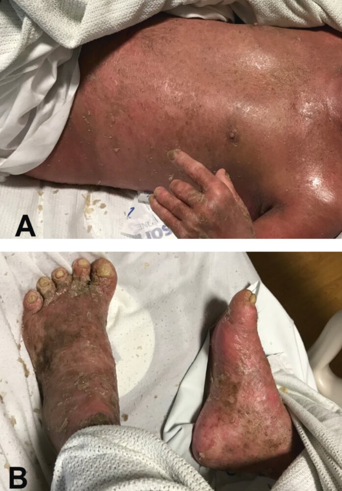 Generalized exfoliative dermatitis