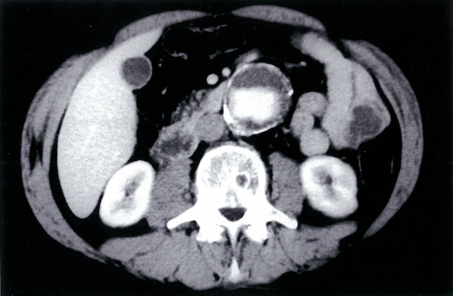Abdominal aortic aneurysm