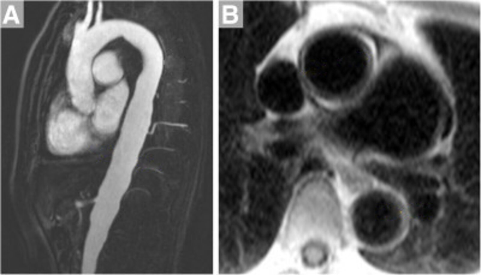 Takayasu arteritis