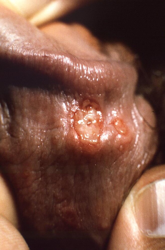 Genital herpes