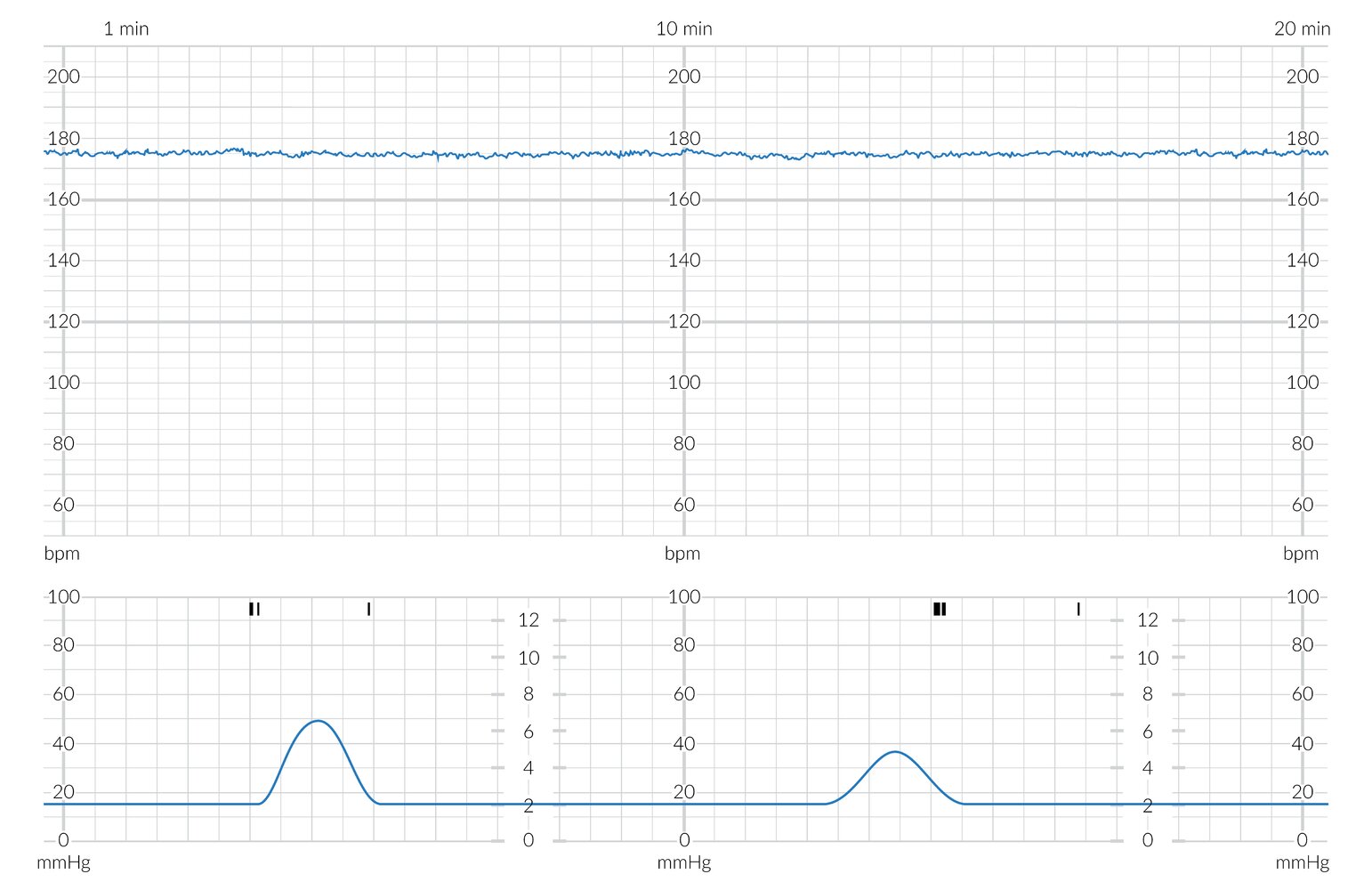 CTG showing mild tachycardia with minimal variability