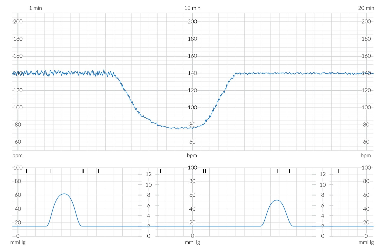 CTG showing prolonged deceleration with minimal variability
