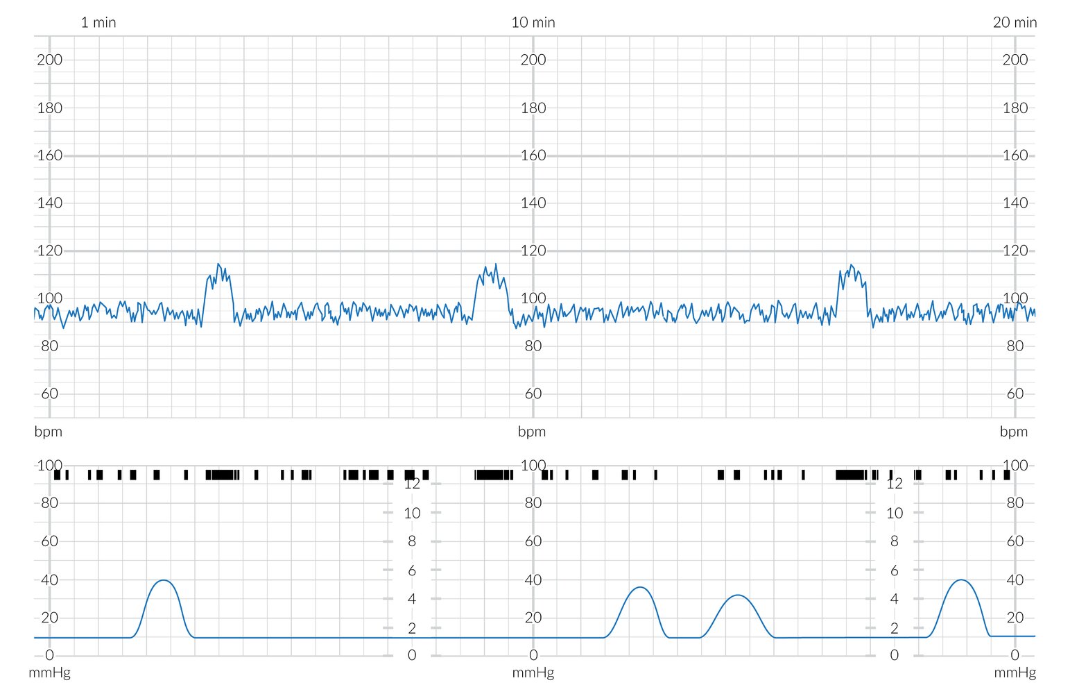CTG showing severe bradycardia with moderate variability and 3 accelerations