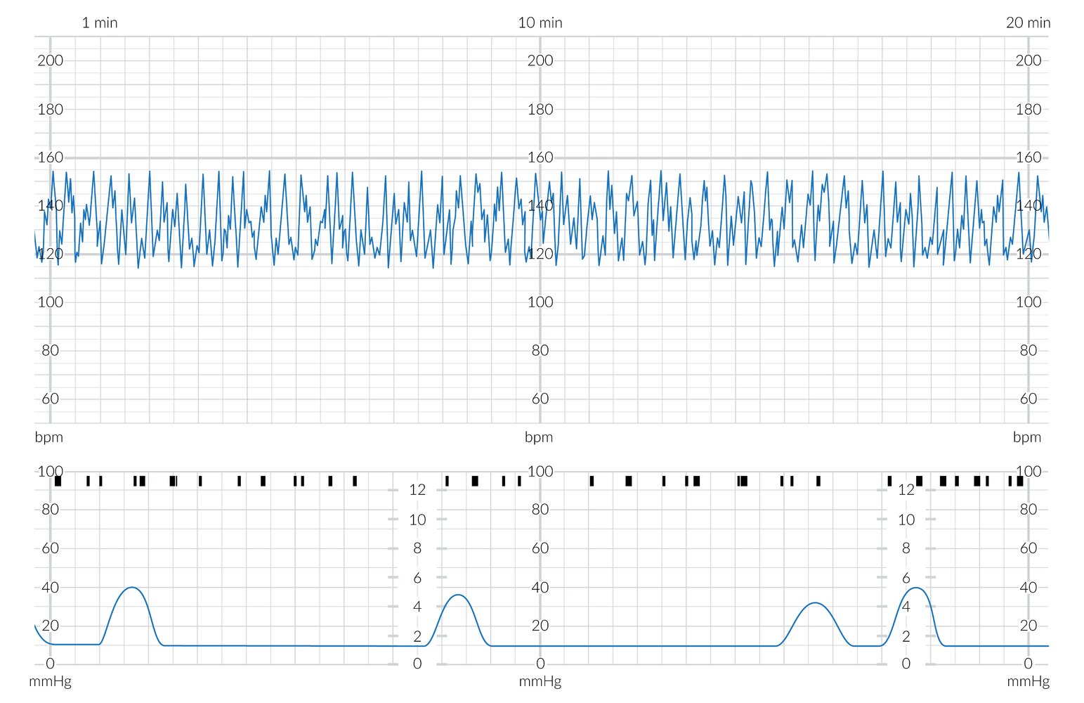 CTG showing marked variability
