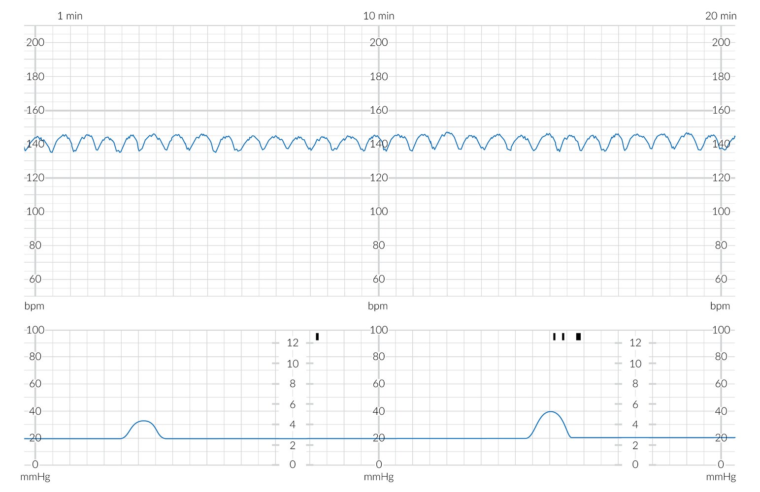 CTG showing sinusoidal variability