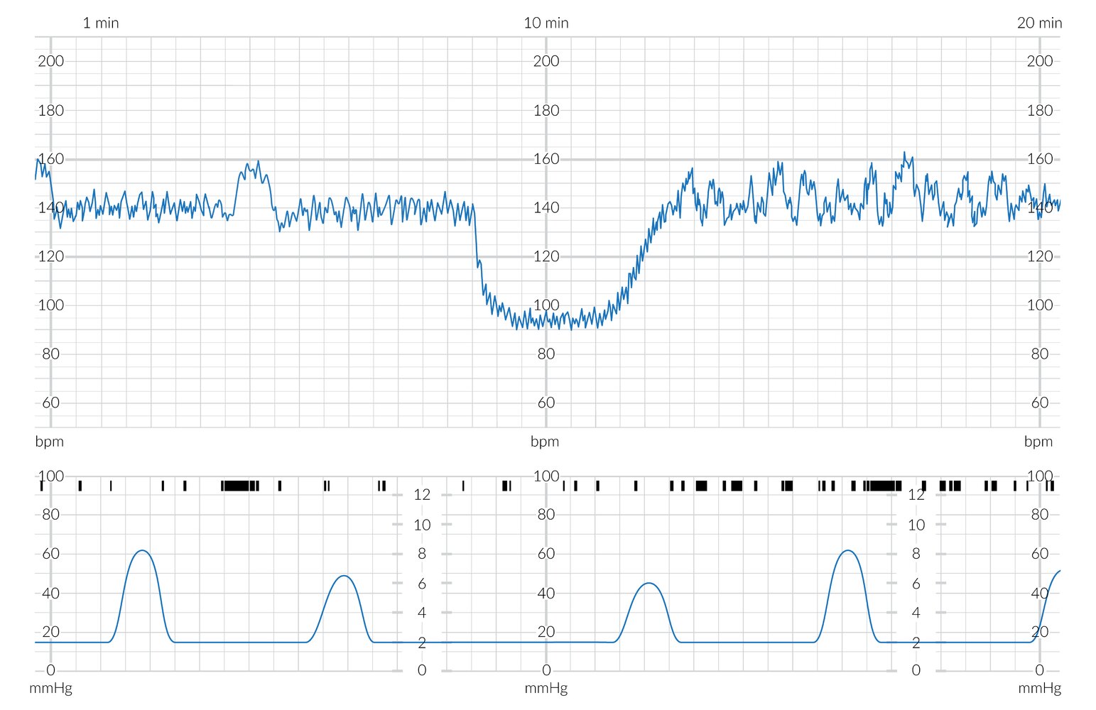 CTG showing prolonged deceleration with normal (moderate) variability