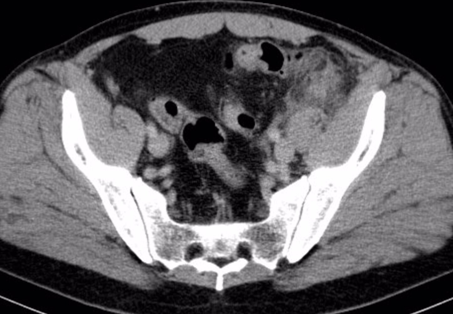 Sigmoid diverticulitis with suspected perforation