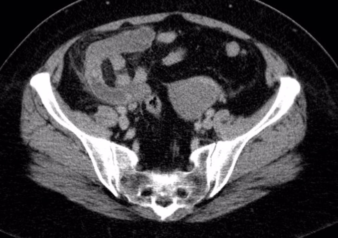 Appendicitis