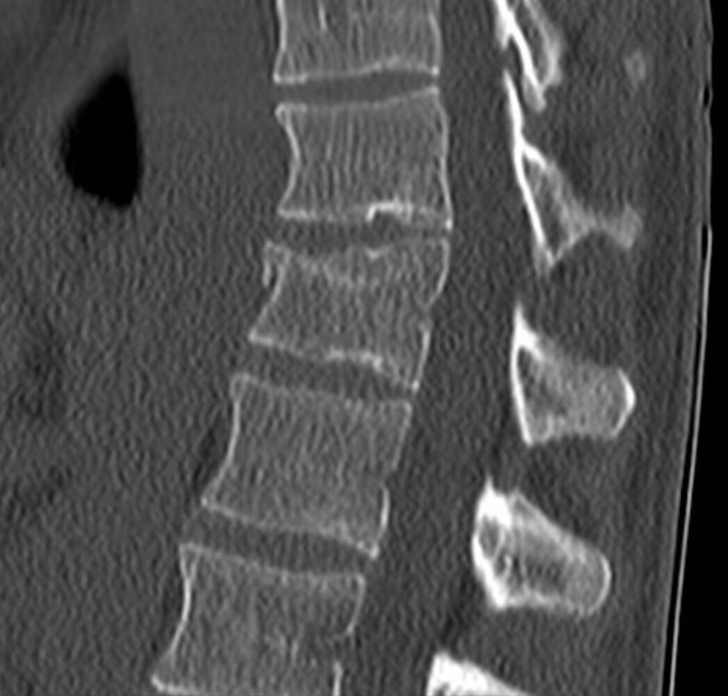Vertebral body wedge fracture