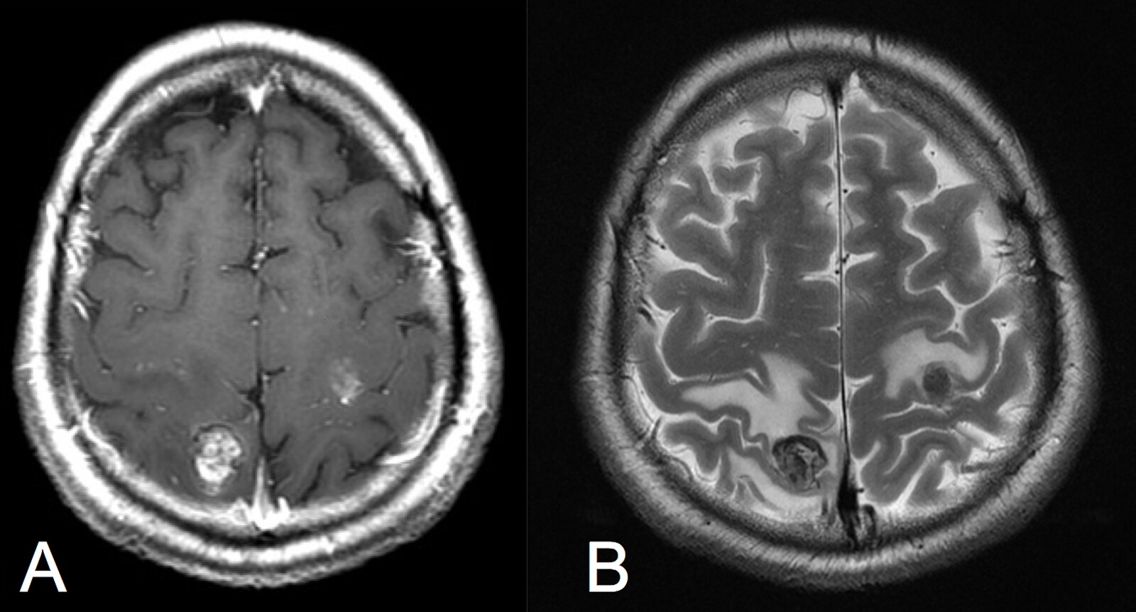 MRI brain with metastatic lesions