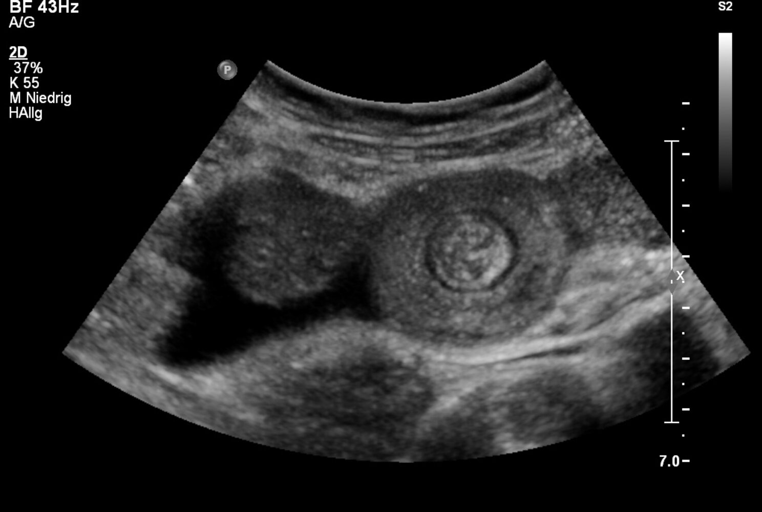 Target sign in intussusception