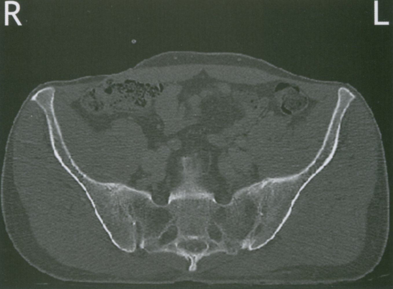 Bilateral sacroiliitis in ankylosing spondylitis
