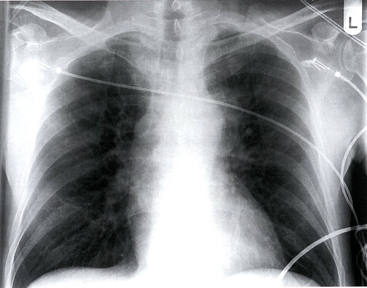 Widened mediastinum secondary to traumatic thoracic aortic injury