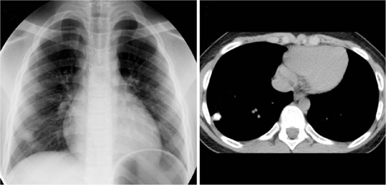 Calcified pulmonary nodule