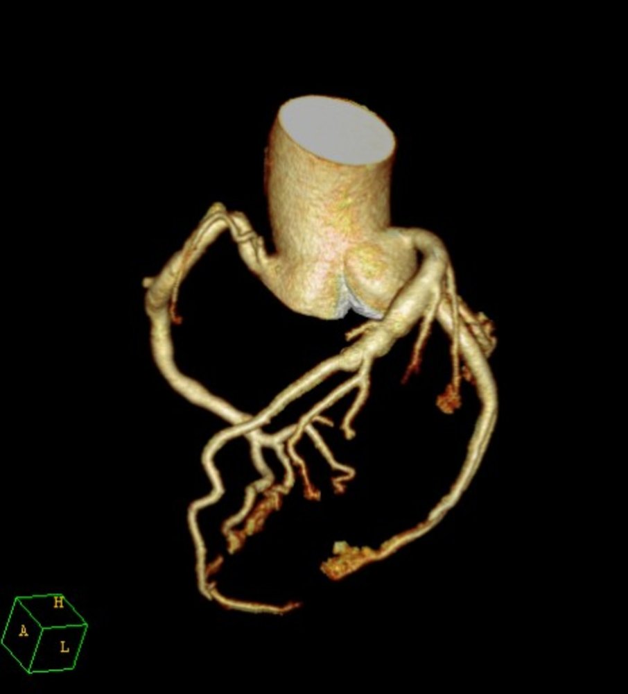 Coronary artery aneurysm in Kawasaki disease