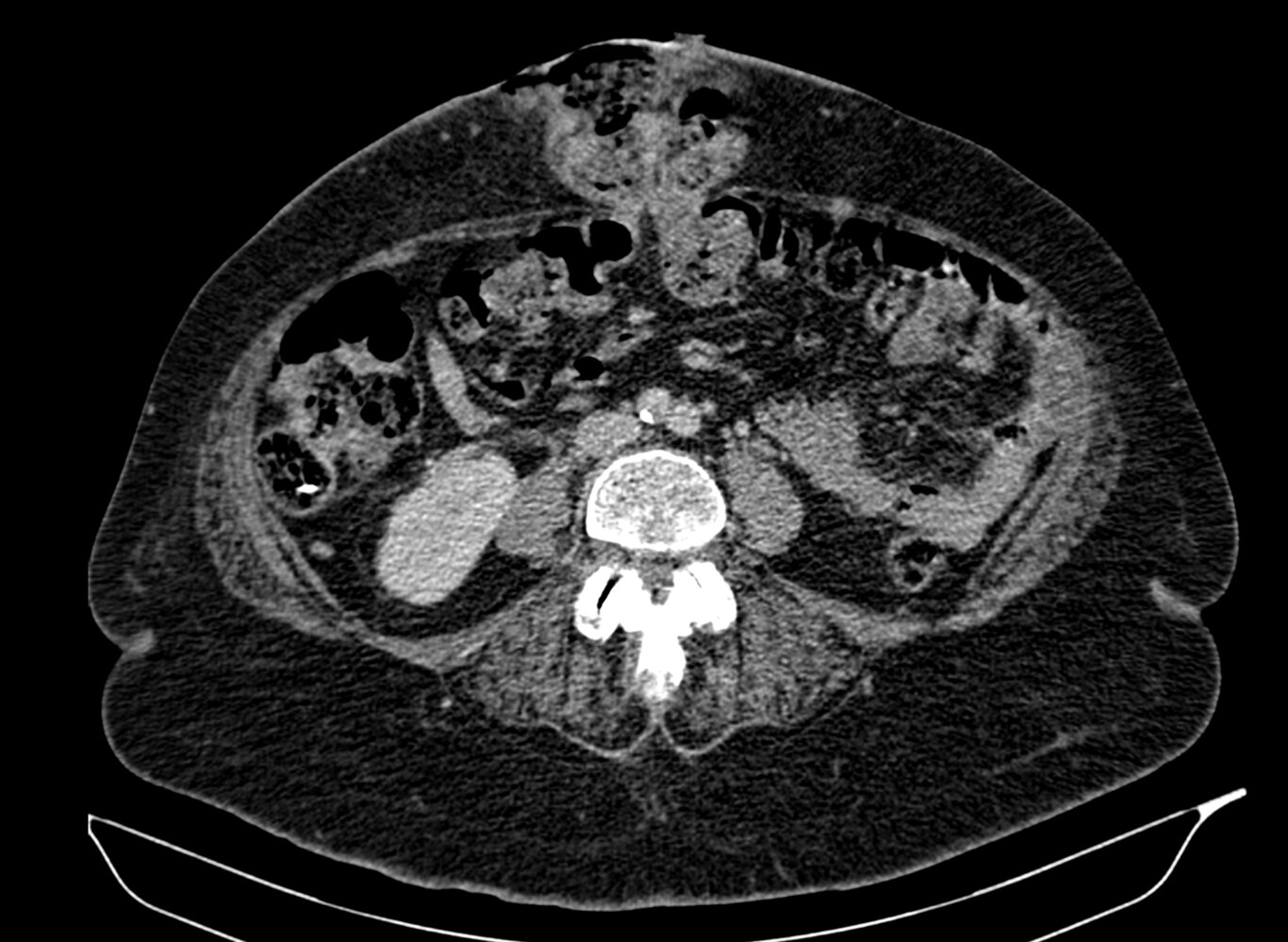 Epigastric hernia with colocutaneous fistula