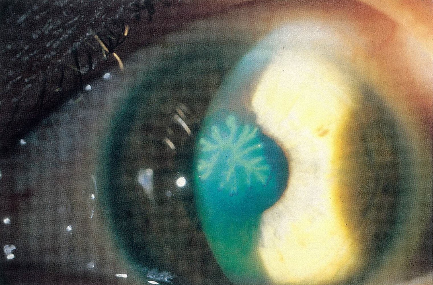 Herpes simplex keratitis
