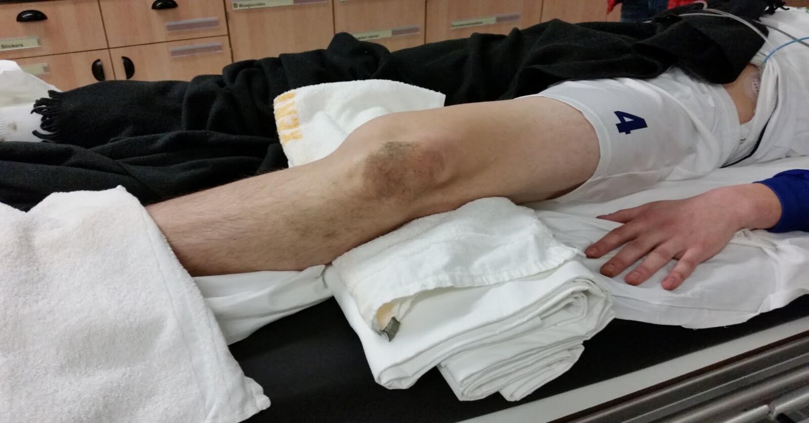 Knee dislocation