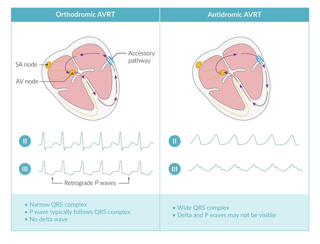 Orthodromic and antidromic AVRT