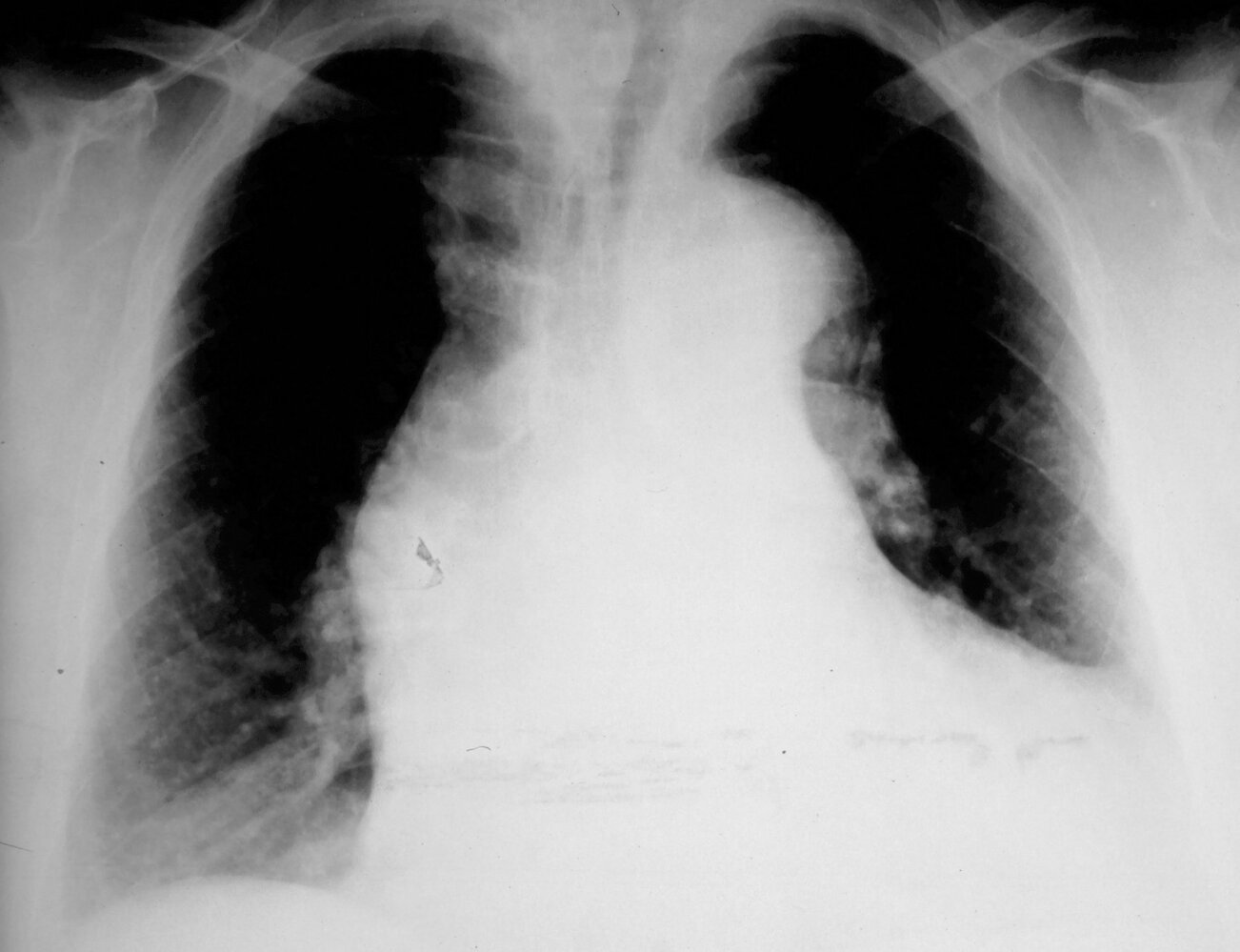 Widened mediastinum