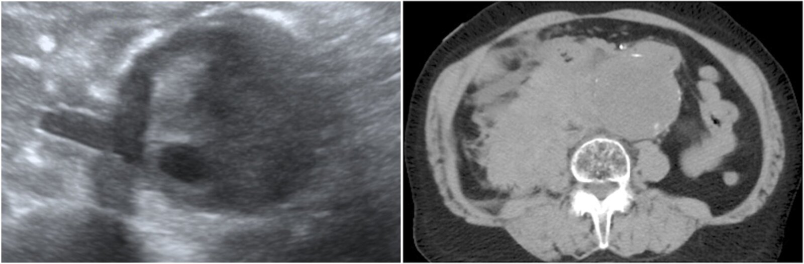 Ruptured abdominal aortic aneurysm (AAA)
