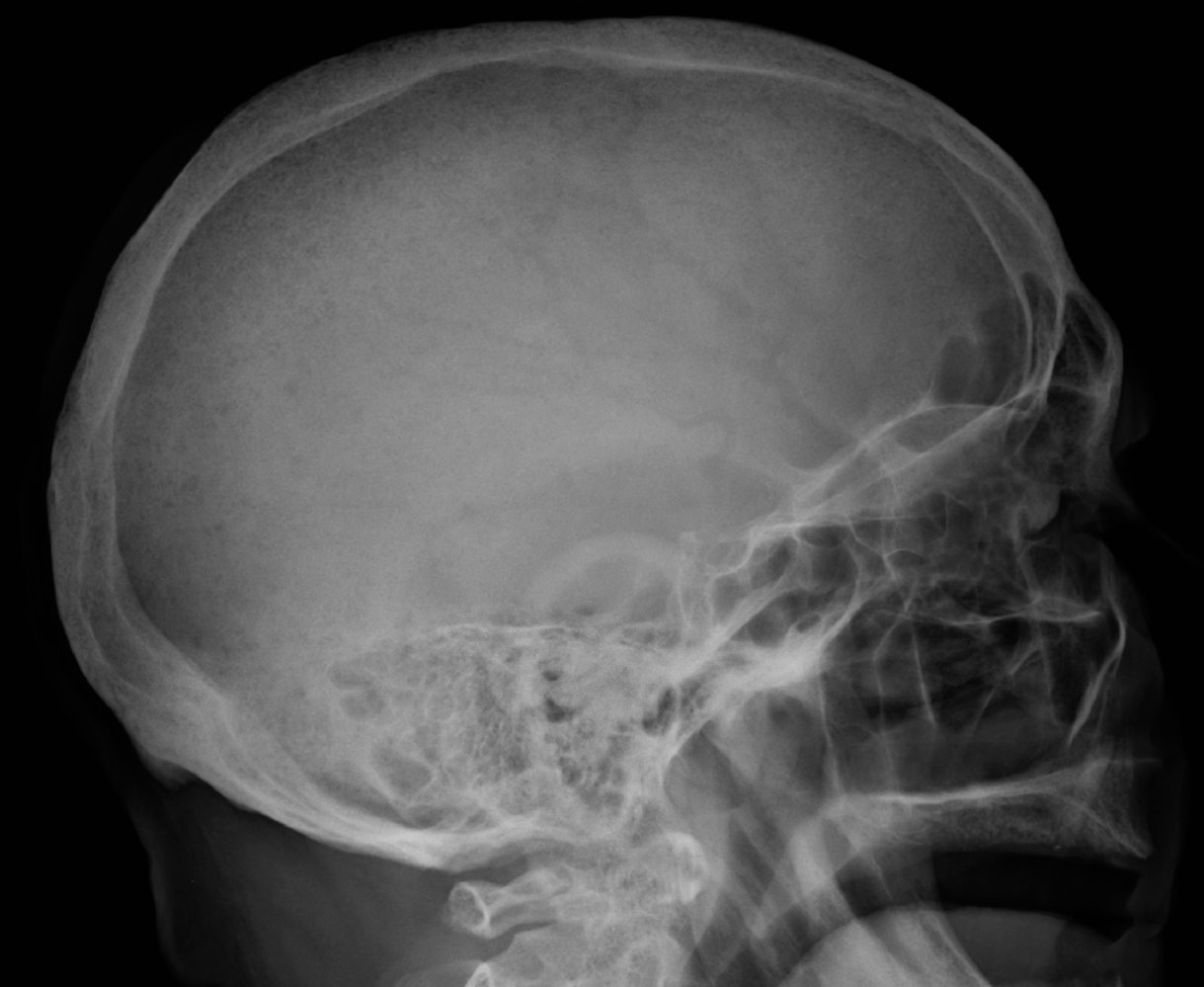 Lytic calvarial lesions in multiple myeloma