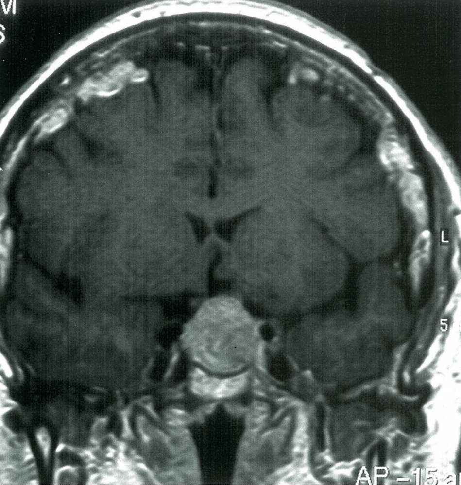 Tumor of the skull base