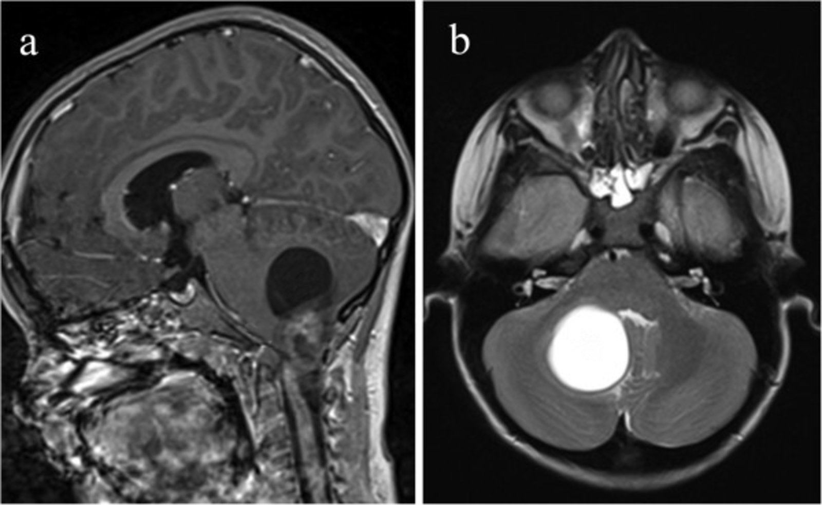 Cerebellar pilocytic astrocytoma