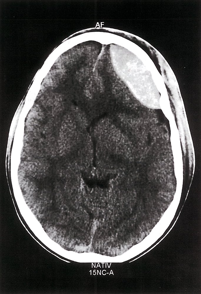 Epidural hematoma