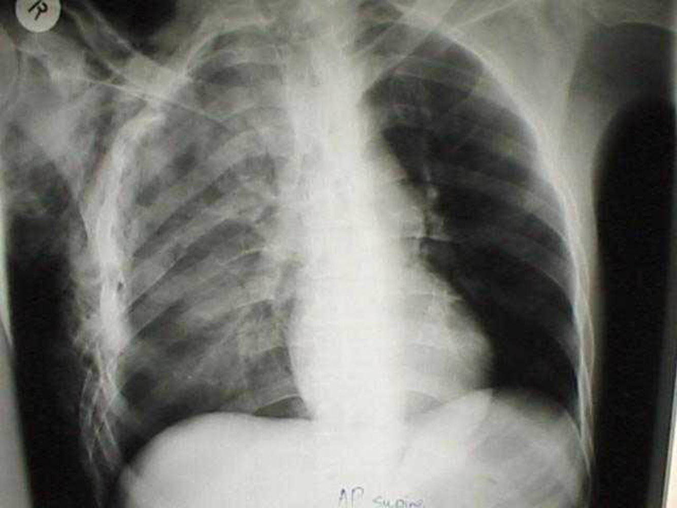 Flail chest