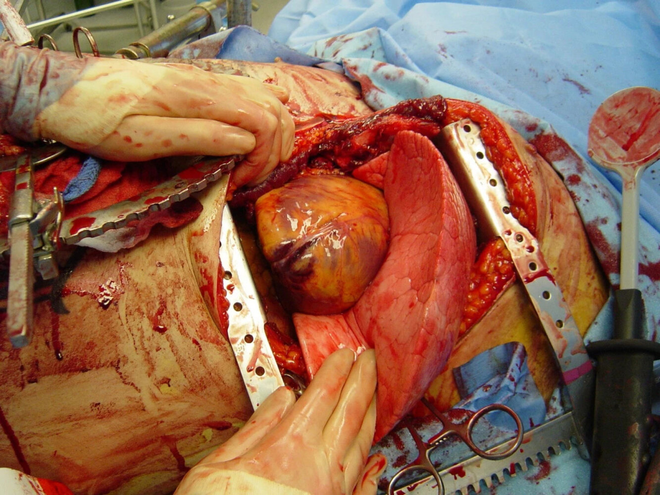 Emergency thoracotomy