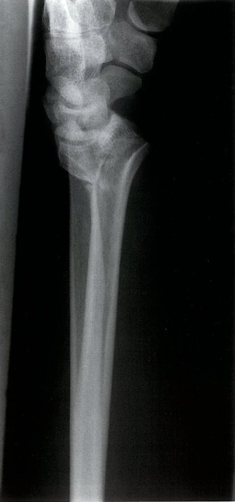Distal radius fracture (2/2)