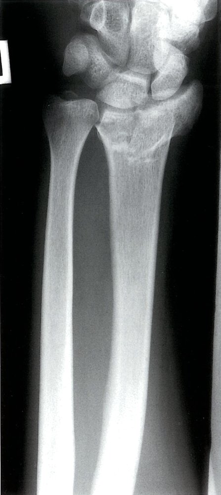Distal radius fracture 1/2