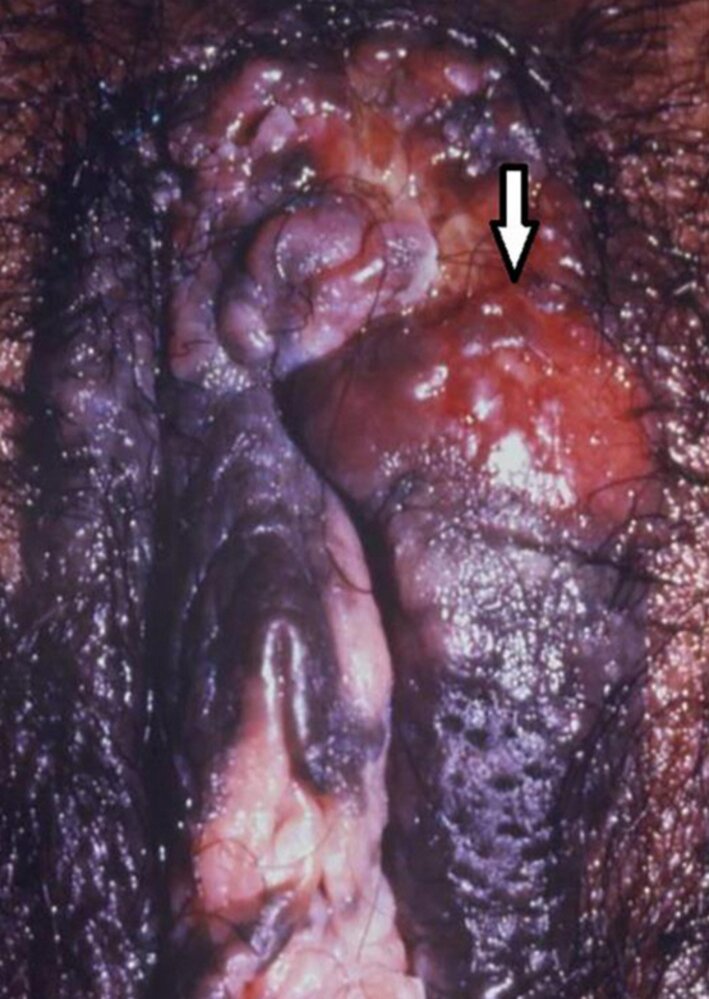 Bowenoid papulosis