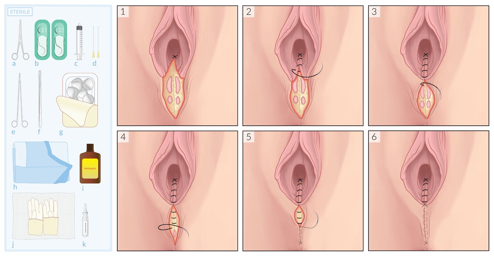 Surgical repair of second-degree perineal laceration