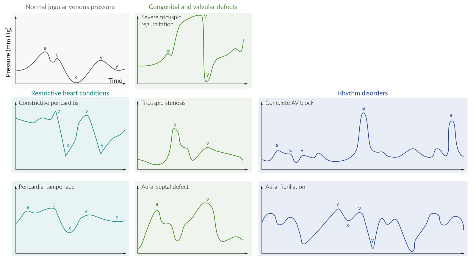 Jugular venous pressure waveforms in common cardiac conditions