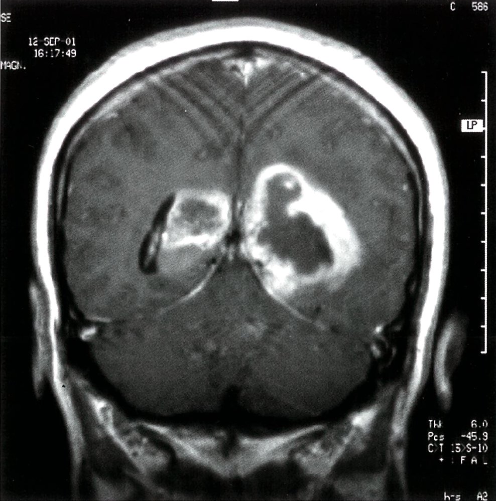 Bilateral glioblastoma (butterfly glioma)