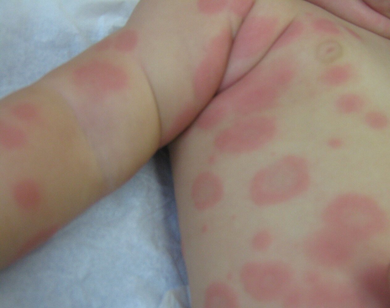 Erythema multiforme