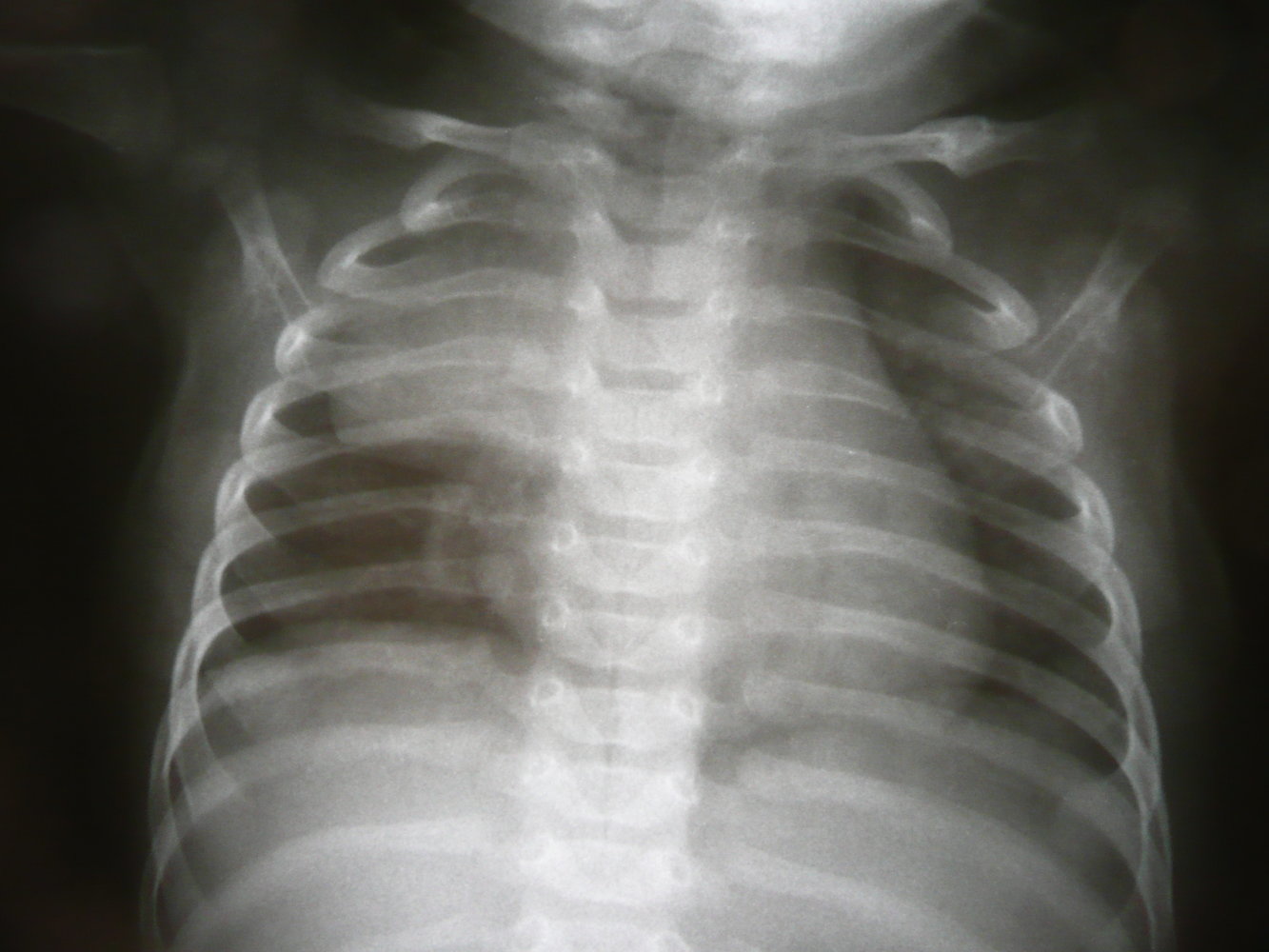 Thymic sail sign