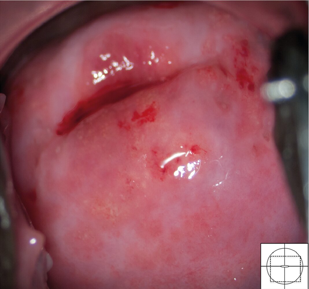 Strawberry cervix and sandy patches