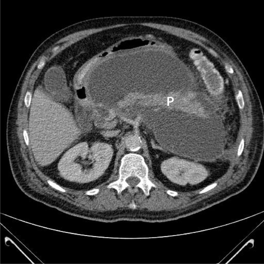 Pancreatic pseudocyst