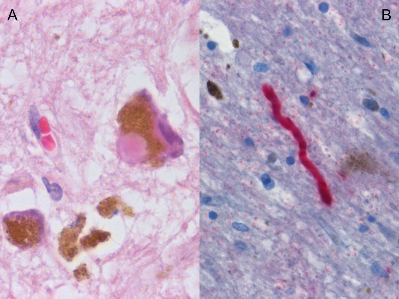 Lewy body and Lewy neurite
