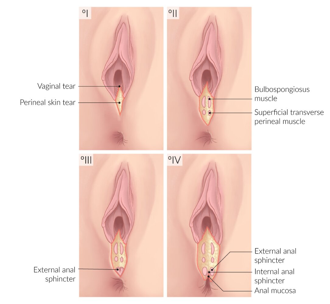 Classification of perineal lacerations
