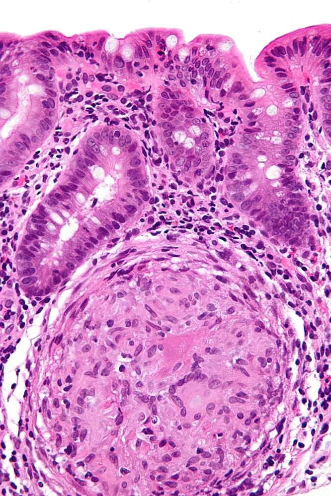 Crohn disease