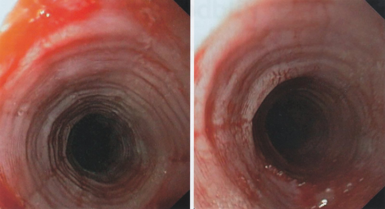 Eosinophilic esophagitis