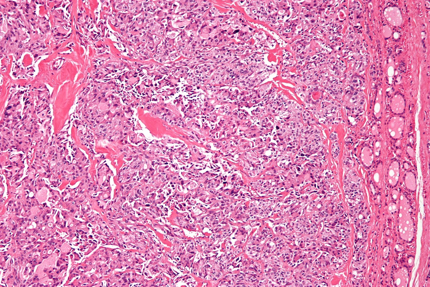 Medullary thyroid carcinoma